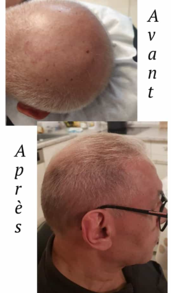 Résultats après traitements chute de cheveux