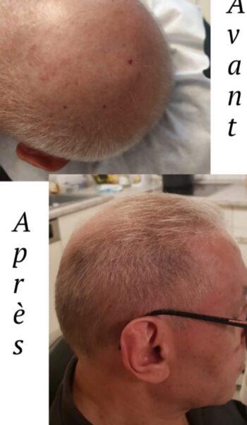 ALOPECIE ANDROGENETIQUE 3 ALOPECIE ANDROGENETIQUE 3